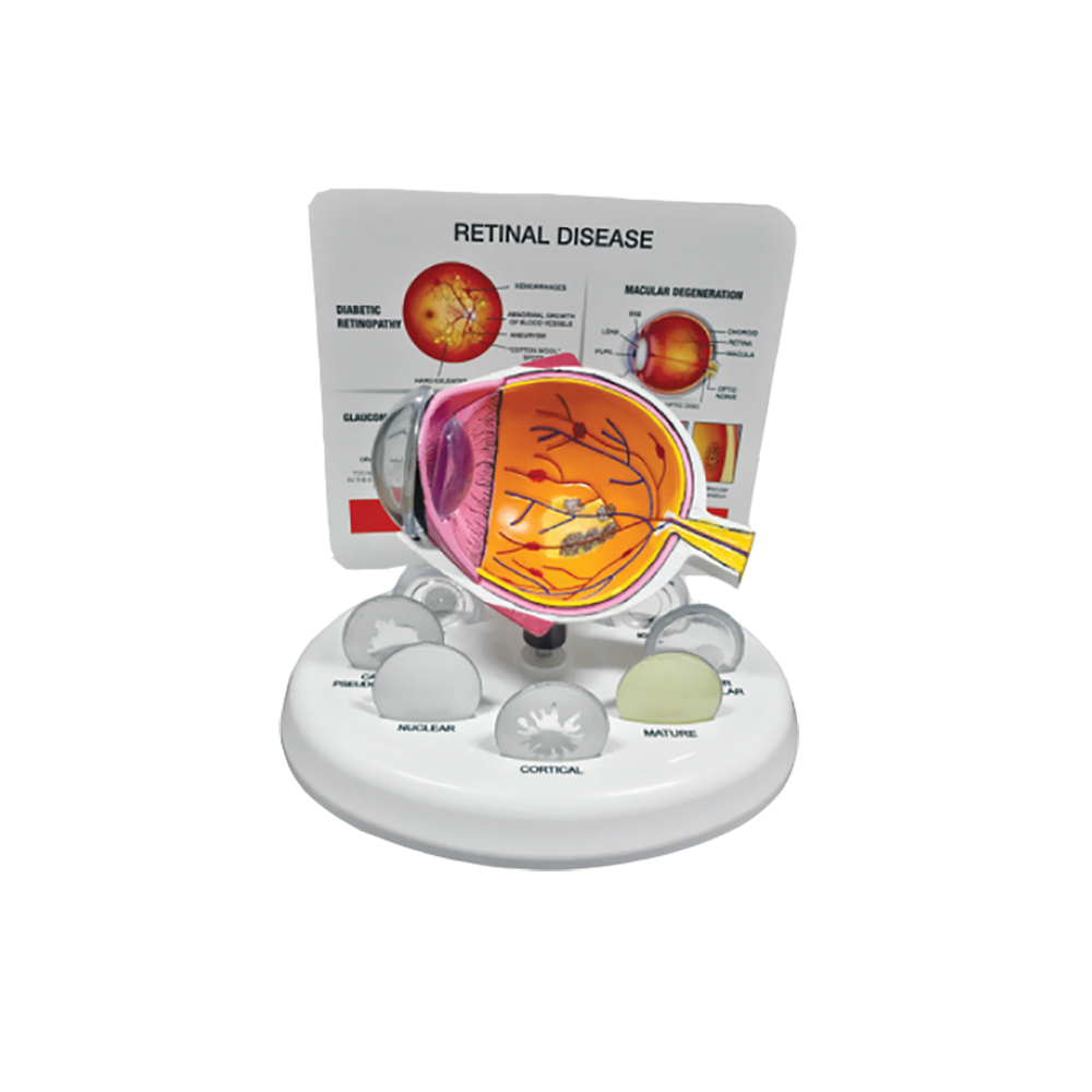 Eye Model - Retinal Disease